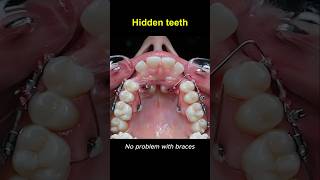 Braces change your smile braces orthodontist dentist [upl. by Hoffmann]