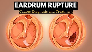 The Science Behind Eardrum Rupture Explained in Simple Terms [upl. by Berke]