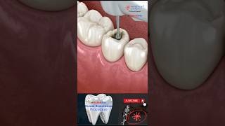 DENTAL RESTRATIUON  COMPOSITE BONDING TEATH dentist trending viralvideo [upl. by Becki]