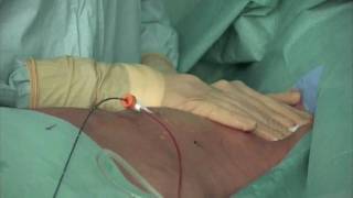 VNUS ClosureFast Treatment of the anterolateral branch GSV [upl. by Nyladnar]