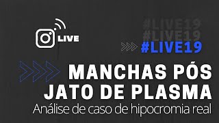 LIVE19  MANCHAS PÓS JATO DE PLASMA [upl. by Zetram883]