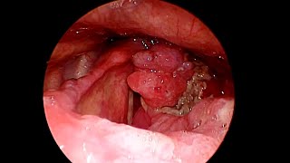 Carcinoma Larynx 29 August 2023 [upl. by Emmuela]