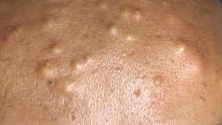 How To Remove Blackheads And Whiteheads On Face Easy 122 ✦ Dr Laelia ✦ [upl. by Paddy712]