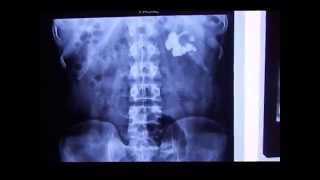 Intravenous Pyelogram  Intravenous Nephrogram  Intravenous Pyelography IVP in Staghorn Calculus [upl. by Bonnee]