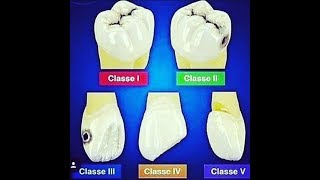 Classification of dental caries [upl. by Atineg]