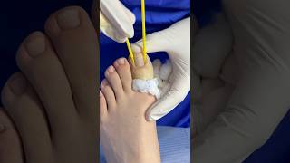 Cauterización química satisfying ingrowntoenailsurgery nails [upl. by Wayolle549]