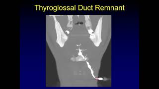 Journal Club Thyroglossal Duct Carcinoma [upl. by Nnanaej]