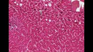 Histopathology LiverCholestasis [upl. by Ancelin]