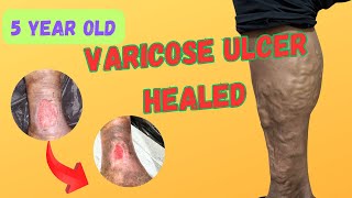 Healed 5 year old ULCER  Best result of Laser treatment  EVLT [upl. by Bart]