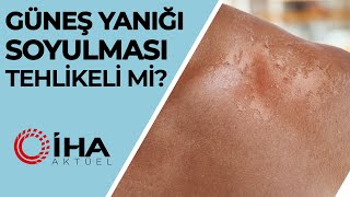 Güneş Yanığı Soyulması Tehlikeli Mi [upl. by Hamford]