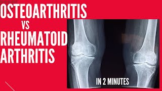 Osteoarthritis vs Rheumatoid arthritis in 2 mins [upl. by Weider]