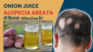 Does Onion Juice Help with Alopecia Areata  Alopecia Areata Treatment in Delhi  SkinQure [upl. by Buxton]