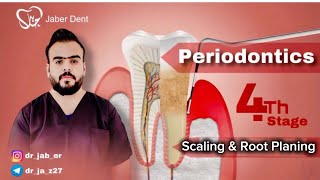 Periodontics   Scaling amp Root Planing [upl. by Rawlinson455]