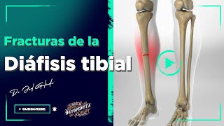 Periostitis Tibial  Estiramientos de Prevención y Tratamiento [upl. by Letnahc689]