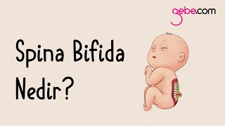 Spina Bifida Nedir Spina Bifida Ameliyatı Nasıl Yapılır [upl. by Huxham]