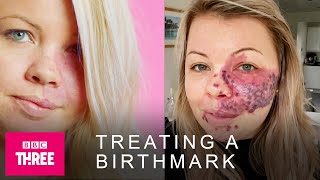 How A Facial Birthmark Is Treated Skin [upl. by Ettenel830]