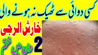 Kharash الرجی ka ilaj alarji خارش ka fori ilaj itching skin alarji ilaj [upl. by Rosaleen]