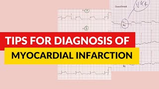 Tips for diagnosis of myocardial infarction ECGEKG interpretation [upl. by Airb]