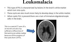 Periventricular Leukomalacia [upl. by Eaton]