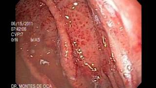 ENDOSCOPIA GASTRITIS EROSIVA [upl. by Iatnwahs]