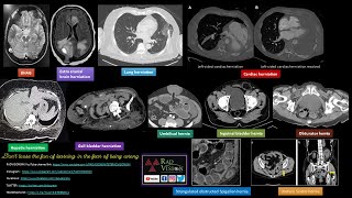 IMAGING IN HERNIAS CASE SPECTRUM [upl. by Salangi]