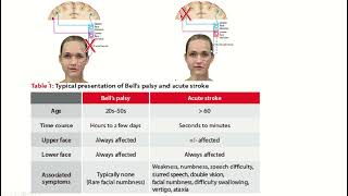 Demystifying Facial Palsy Easy Explanation of Bells Palsy and StrokeRelated Facial Palsy [upl. by Aiyram]