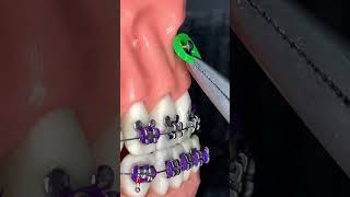 🔥Instalación de un microimplante dental durante el tratamiento de los brackets 😬🔥 [upl. by Jewett539]