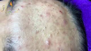 Hien Nguyen Acne 112 Relaxing Blackheads Removal [upl. by Rodi671]