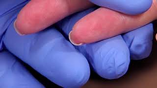 Perform a Capillary Puncture Obtain a Blood Sample by Capillary Puncture [upl. by Fusuy212]