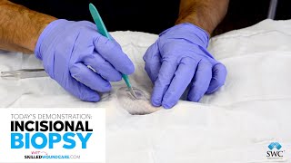 Incisional Biopsy Demo  Skilled Wound Care [upl. by Hara]