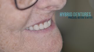 Hybrid DENTURES Process Before and After dentures smile dentistry painting teeth [upl. by Olegna]