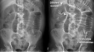 X ray of Small Bowel Obstruction [upl. by Handbook]