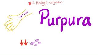 Pupura  Bleeding Disorders [upl. by Einoj]