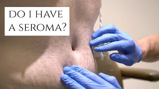 What is a Seroma  Fluid Build Up After Surgery  Symptoms and Treatment  Dr Daniel Barrett [upl. by Eissert]