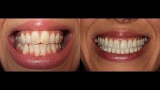 Invisalign Time Lapse UPDATED [upl. by Neltiak]