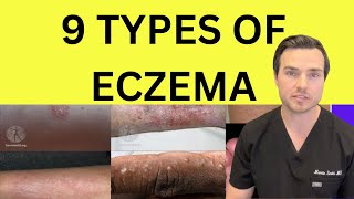 All 9 types of Eczema explained by Dr Martin Smith [upl. by Wardlaw]