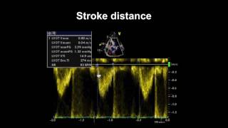 Echocardiography Essentials Assessing left ventricular global systolic function LVF [upl. by Pinckney]