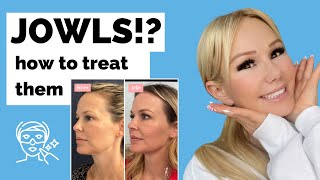 JOWLS How to treat them without surgery Thermafrax thread lifts fillers botox more [upl. by Carmela]