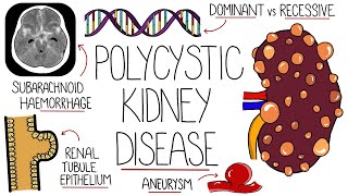 Polycystic Kidney Disease Explained [upl. by Olfe]