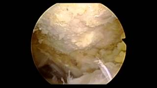 Shoulder Arthroscopy amp Subacromial Decompression [upl. by Idoc965]