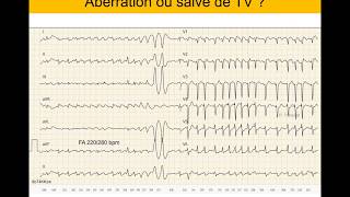 Tachycardie ventriculaire ou supraventriculaire  Quiz ECG Dr Taboulet [upl. by Ikcin97]