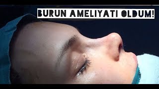 BURUN AMELİYATI OLDUM  EstetikDeviasyon Fotoğraflarla Ameliyat Süreci [upl. by Akemej]