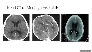 meningitis bakterial [upl. by Aihtibat]