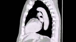 Lytic lesions in multiple myeloma lower res [upl. by Irme]