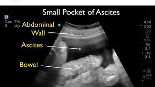 Ultrasound video showing Ascites ascites medicalmasti  ultrasoundvideoascites medicalmasti [upl. by Eniaral]