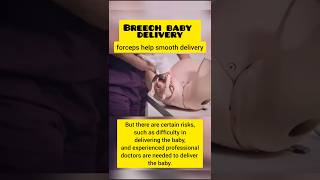 Breech Baby Delivery 🤰  breech baby medicalstudent satisfying medical shorts [upl. by Magna]