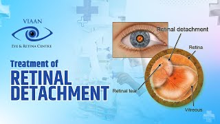 Treatment of Retinal Detachment  Dr Neeraj Sanduja  Retina Specialist  Viaan Eye amp Retina Centre [upl. by Bass]