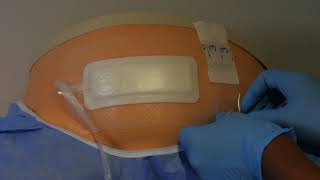 Application of Avelle NPWT System following a caesarean section [upl. by Hobard]