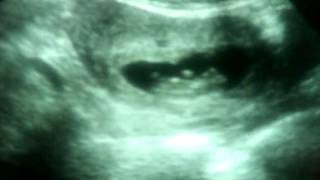 feto de 10 semanas 2 días con movimientos espontáneos Fetal of 10 weeks with spontaneous movements [upl. by Filmore232]