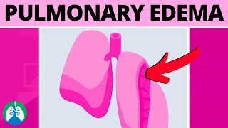 Pulmonary Edema Medical Definition  Quick Explainer Video [upl. by Ynnus842]